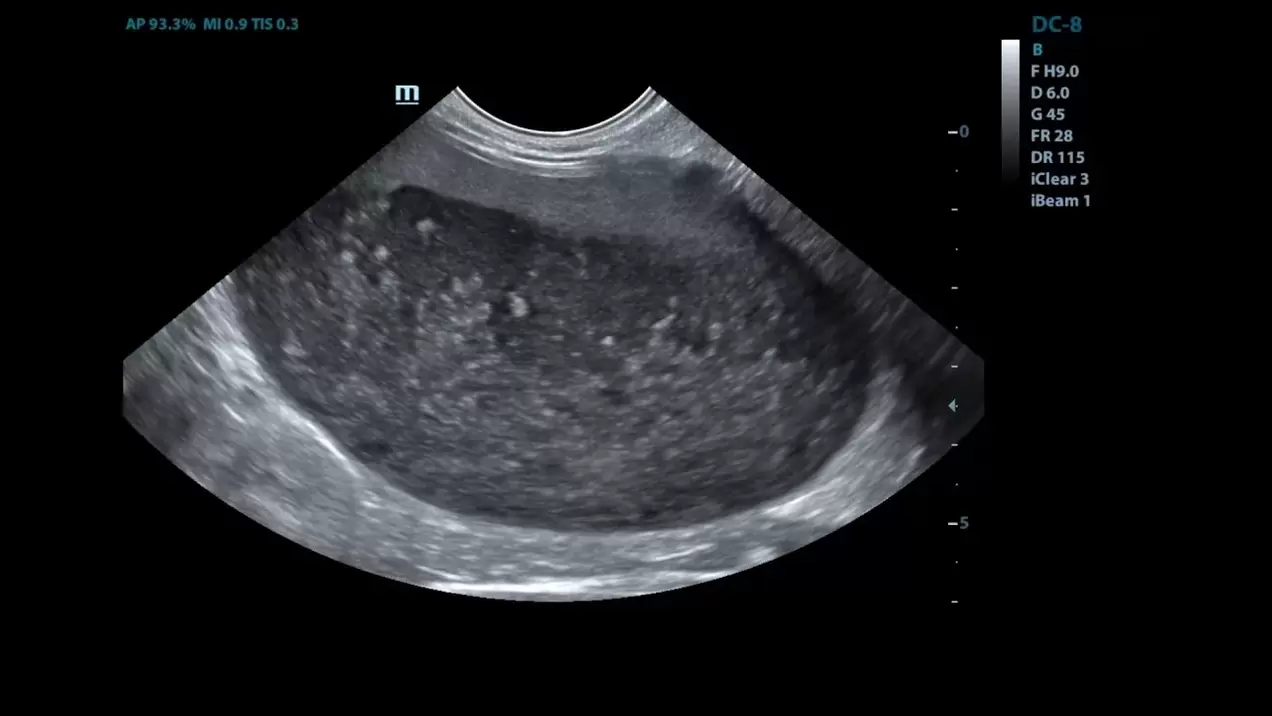 Cystitis in mijn echografie -afbeeldingen vóór het gebruik van Cystolax