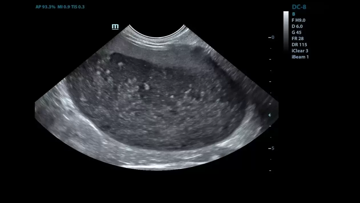 Cystitis in mijn echografie -afbeeldingen vóór het gebruik van cystolax