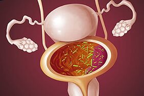 Bacteriële cystitis bij een vrouw